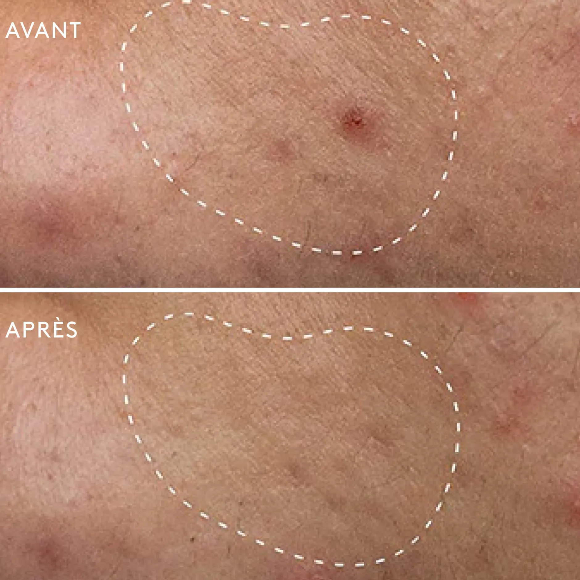 Soins Ciblés*Dermalogica Deep Breakout Liquid Patch Anti-Imperfections